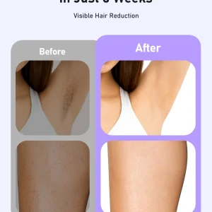 IPL Hair Removal Device - Thumbnail Image 4