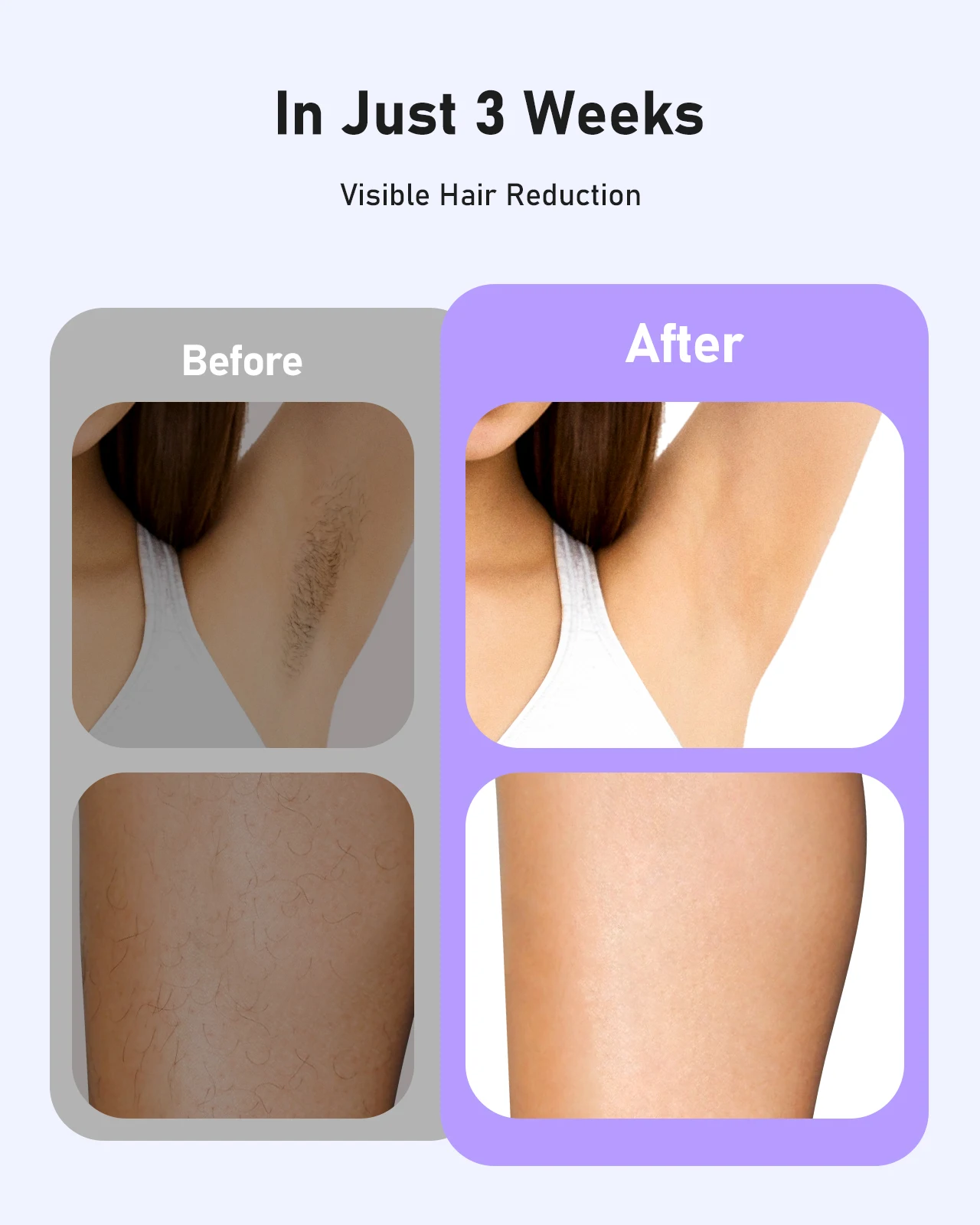 IPL Hair Removal Device - Image 4